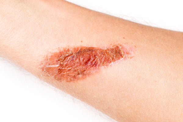 Hypochlorous Acid as a Potential Wound Care Agent